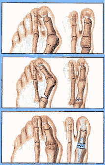 Bunion Podiatry Treatment