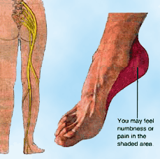 Podiatry Sciatic Referred Pain Diagram