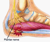 Podiatry Plantar Fasciitis Diagram