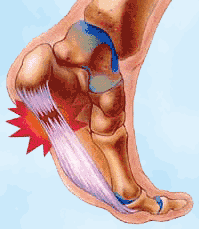 Heel Spur Podiatry Diagram