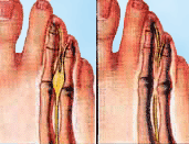 Neuroma Podiatry Diagram